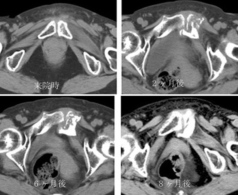 Pubic Osteolysis